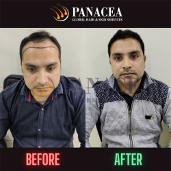 Hair Transplant Before and After Result in Delhi